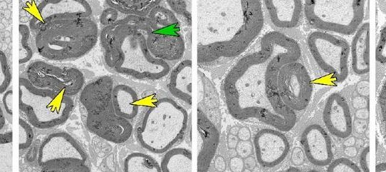 Wichtiger molekularer Mechanismus der Charcot-Marie-Tooth Krankheit entdeckt