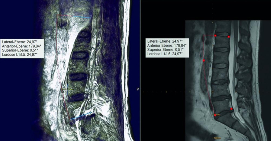 Digitale präoperative Planung in der Wirbelsäulenchirurgie